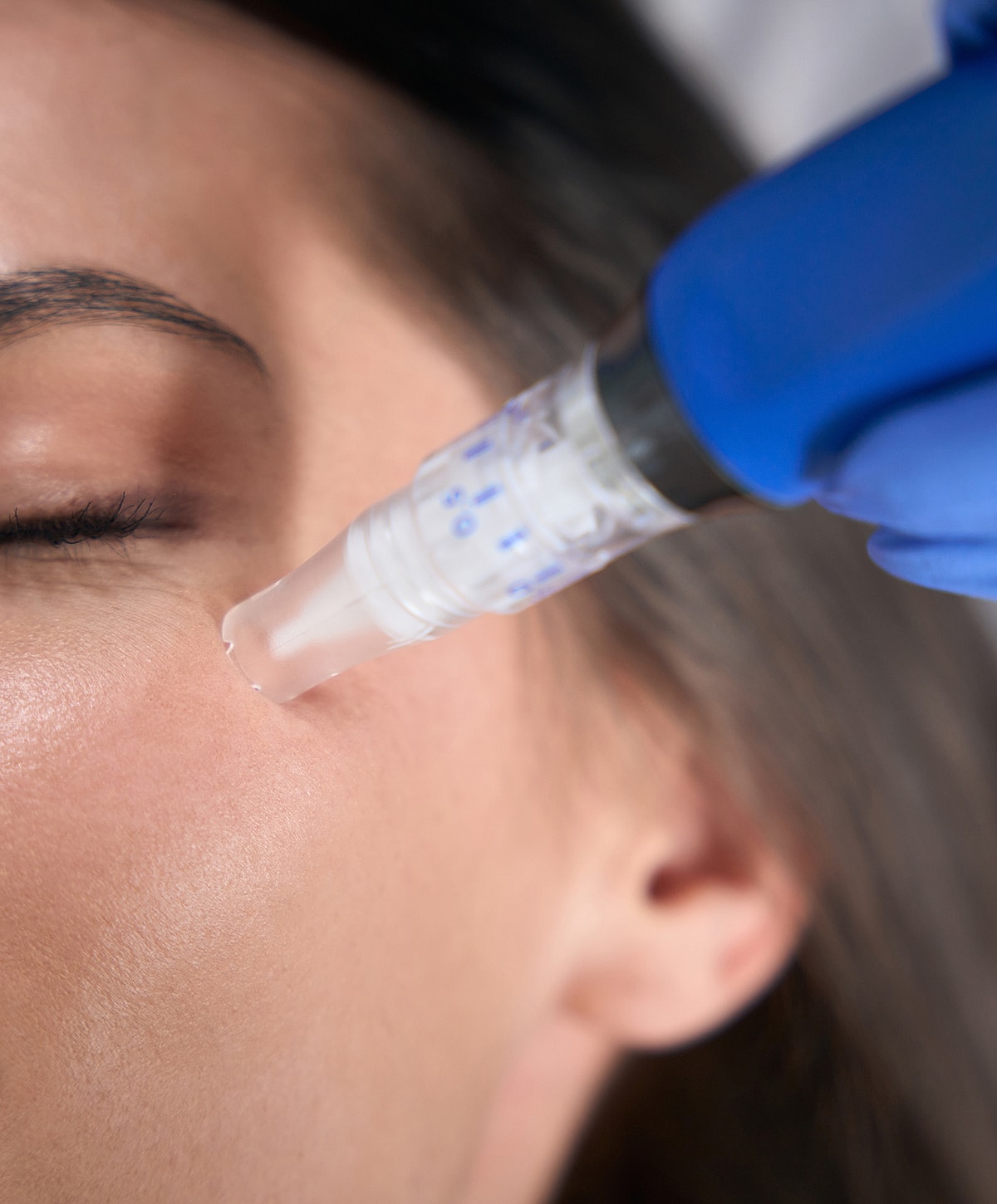 Microneedling treatment on a woman's face.