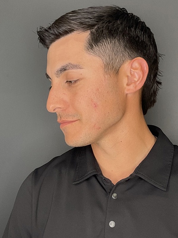 Laser Treatments Gallery Before & After