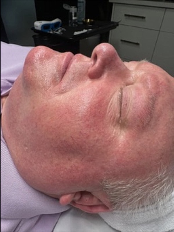 Laser Treatments Gallery Before & After
