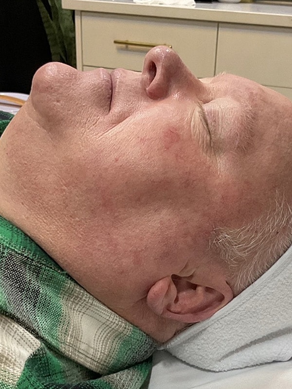 Laser Treatments Gallery Before & After