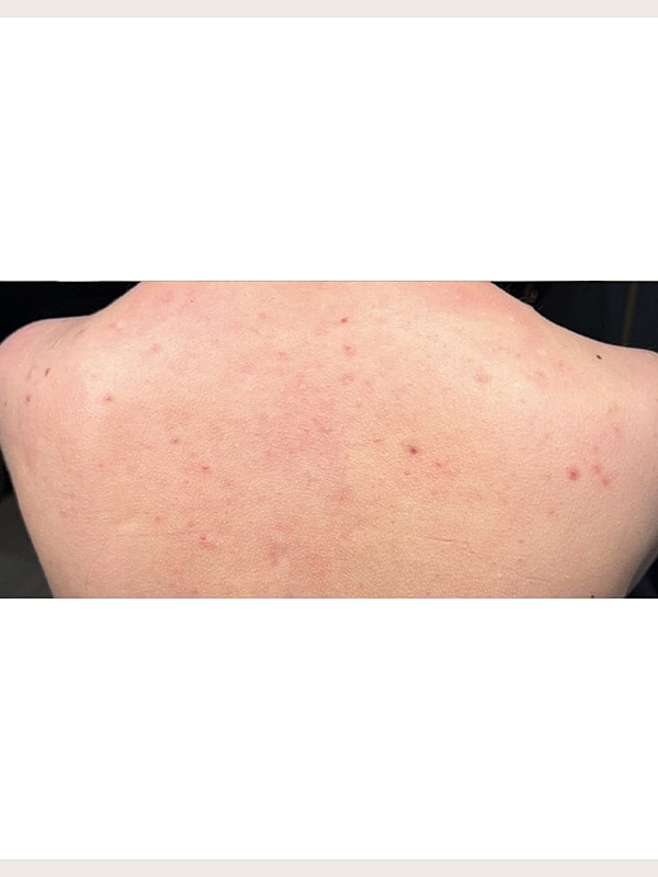 Laser Treatments Gallery Before & After