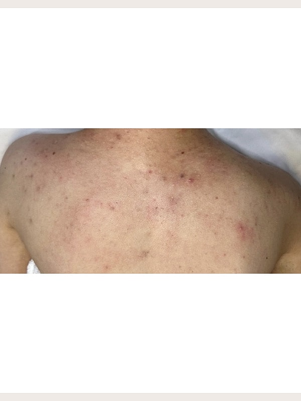 Laser Treatments Gallery Before & After
