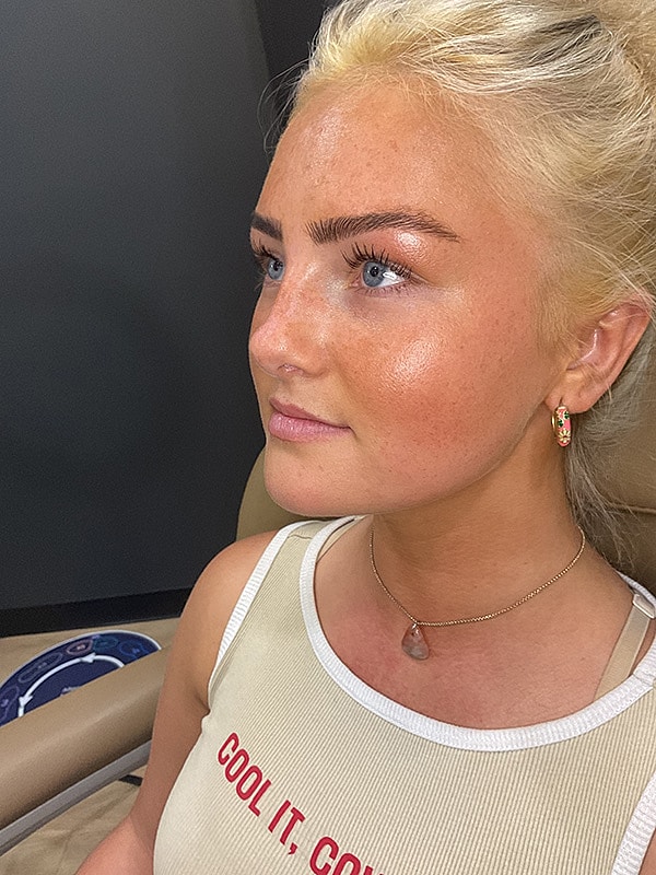 Lip Filler Gallery Before & After