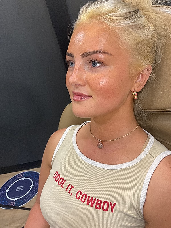 Lip Filler Gallery Before & After