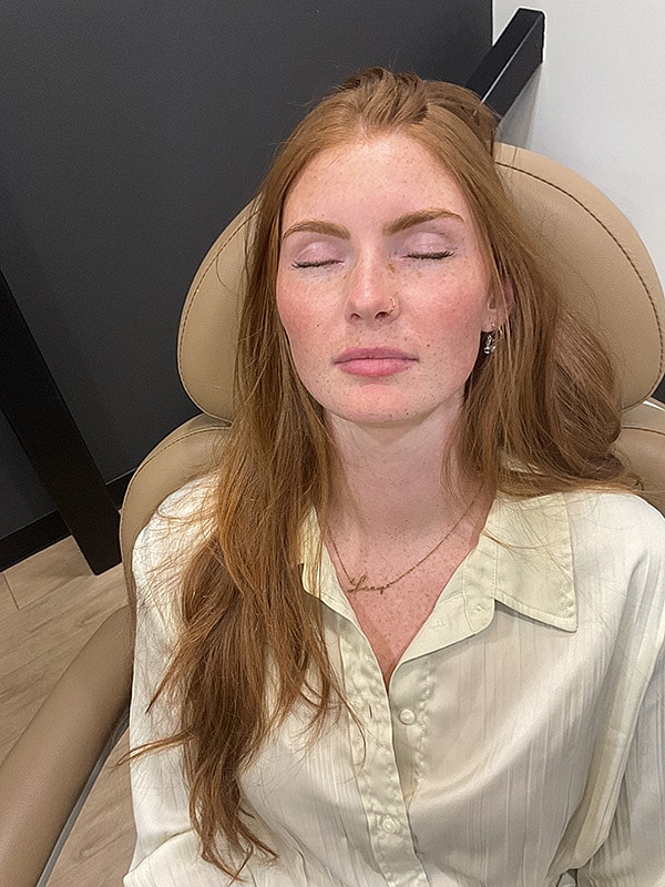 Lip Filler Gallery Before & After