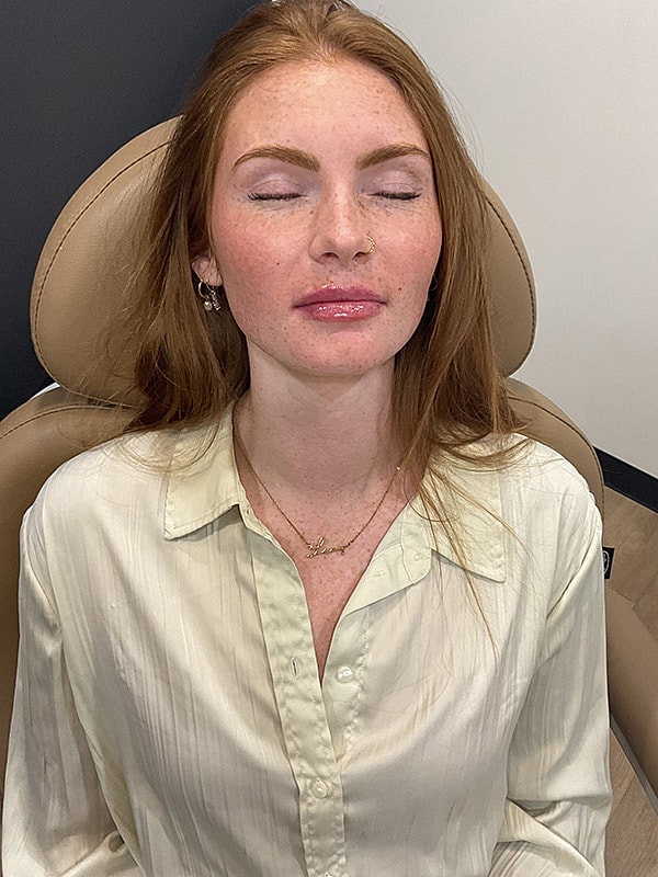 Lip Filler Gallery Before & After