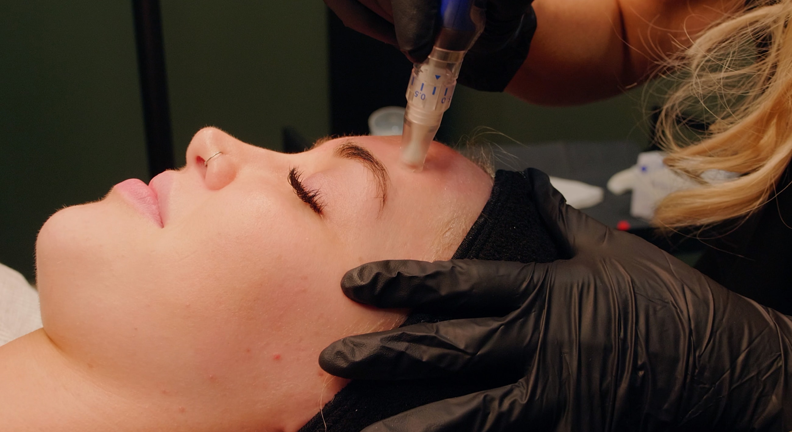 Microneedling treatment on a woman's face.